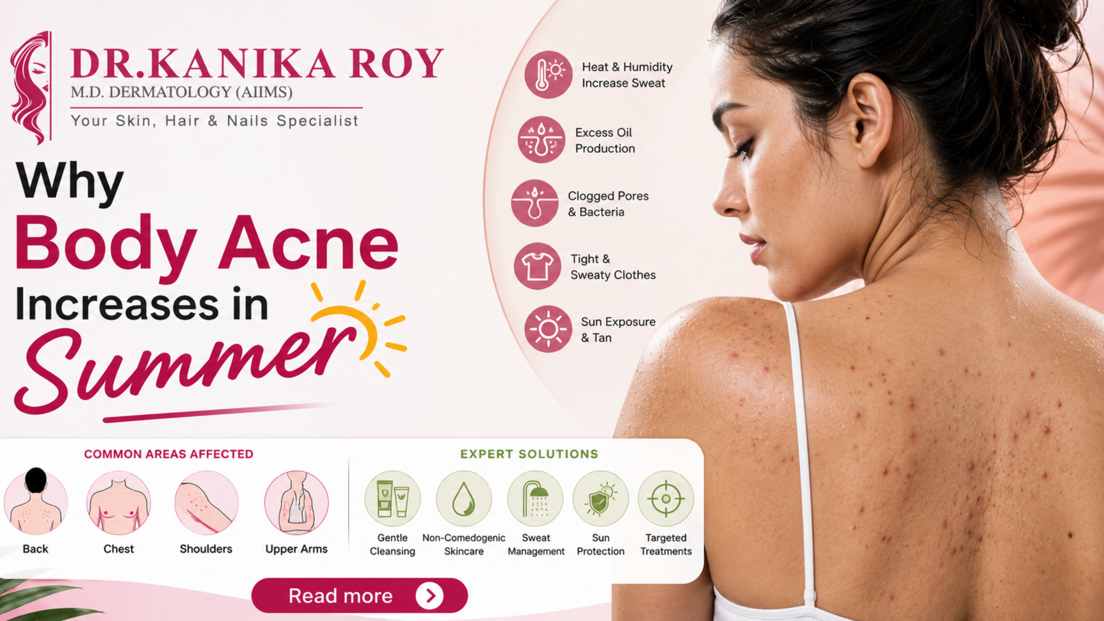 Why Body Acne Increases in Summer